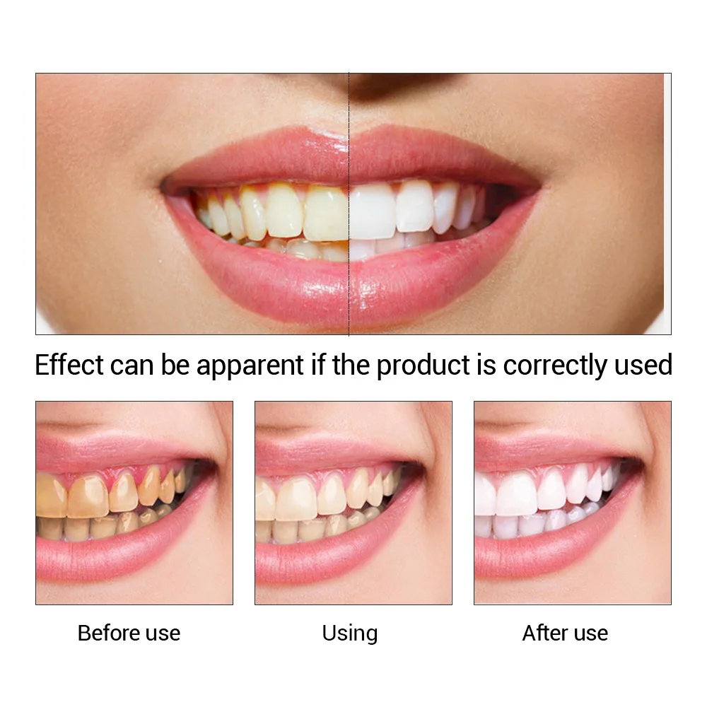 FTEENPLY Zahnaufhellung Essenz – Teeth Whitening Ulta Bewertung und Preis