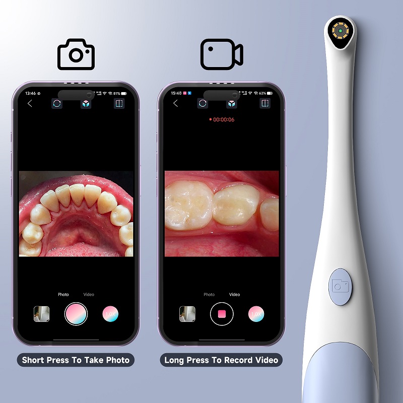 Orale Endoskopkamera 1440P Fot – Teeth Whitening Video Bewertung und Preis