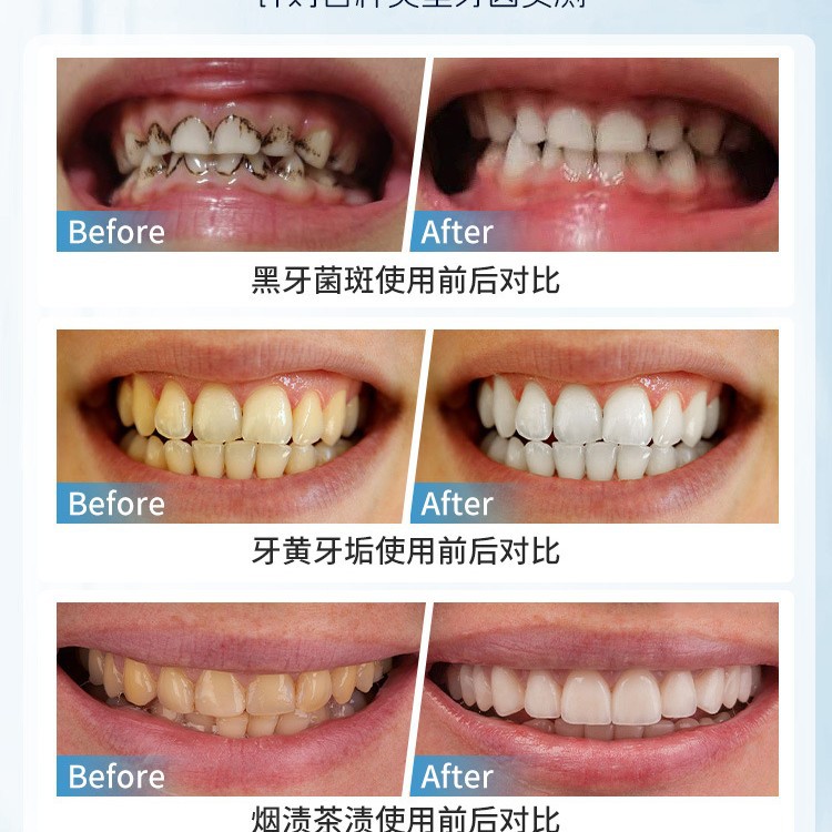 Japan Manuelle Zahnfleckenentf – Teeth Whitening Japan Bewertung und Preis