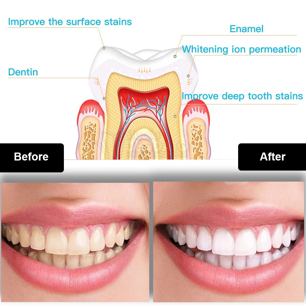 Dental Zahnaufhellung Kit Mini – Teeth Whitening Ulta Bewertung und Preis